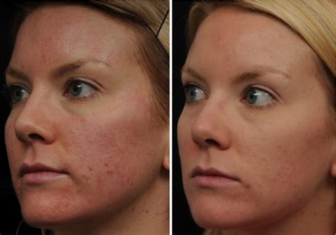 Best Acne Scars Treatment Products Acne Treatment Program At Home