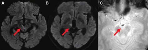 Preoperative Mri Dwi Shows Hyper Intense Signals In The Right Cerebral