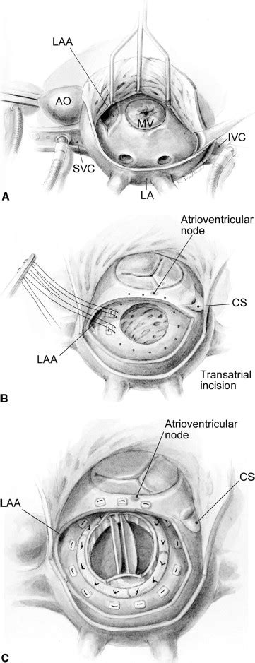 Supra Annular Mitral Valve Replacement In Children The Annals Of