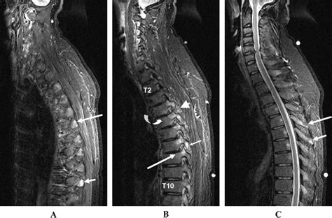 Systematic Assessment Of Inflammation By Magnetic Resonance Imaging In