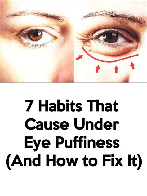 7 Habits That Cause Under Eye Puffiness And How To Fix It In 2021