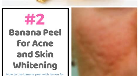 2 Quick Ways To Use Banana Peel For Acne Scars And Skin Whitening