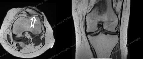 Patellofemoral Arthritis Of The Knee An Overview