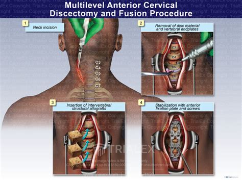 Multilevel Anterior Cervical Discectomy And Fusion Procedure Tr