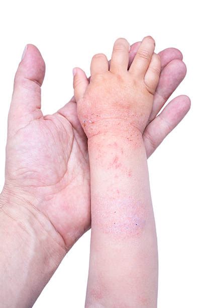 Best Dry Cracked Skin Condition Eczema Stock Photos Pictures And Royalty