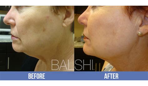 Before And After Gallery South Florida Dermatology