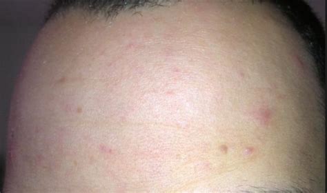 Persistent Forehead Only Acne Folliculitis Pics General Acne