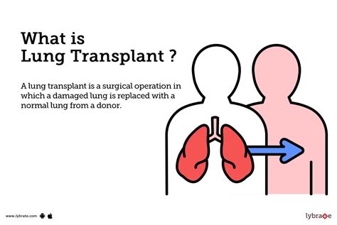 Lung Transplant Causes Symptoms Treatment And Cost