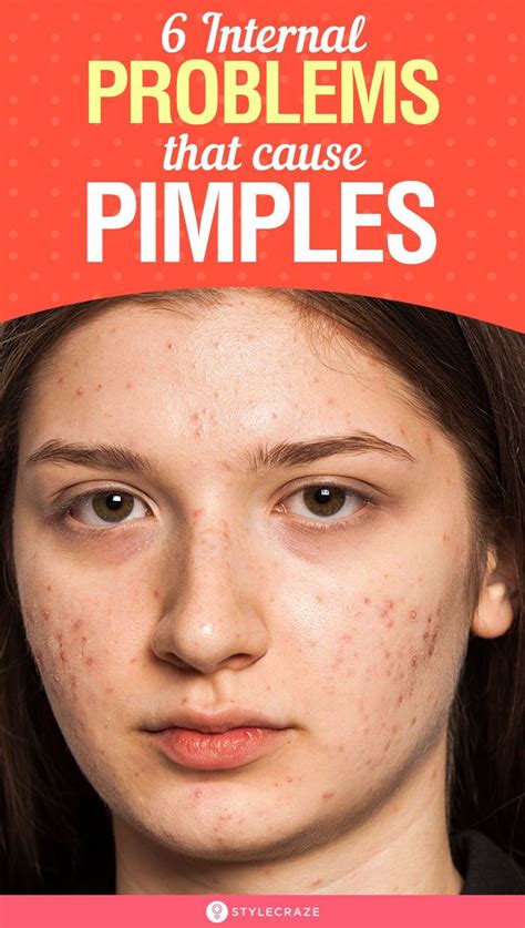 6 Internal Problems The Pimples On Your Face Scream Cheek Pimples