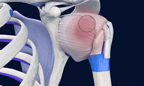 Frozen Shoulder Syndrome Osteo Health Osteopath Clinic In Calgary