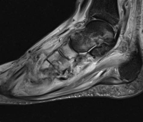 Charcot joint | Image | Radiopaedia.org