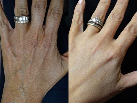 Hand Rejuvenation Berman Cosmetic Surgery