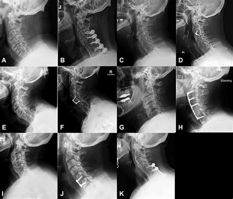 Anterior Cervical Osteophyte Resection For Treatment Of Dysphagia