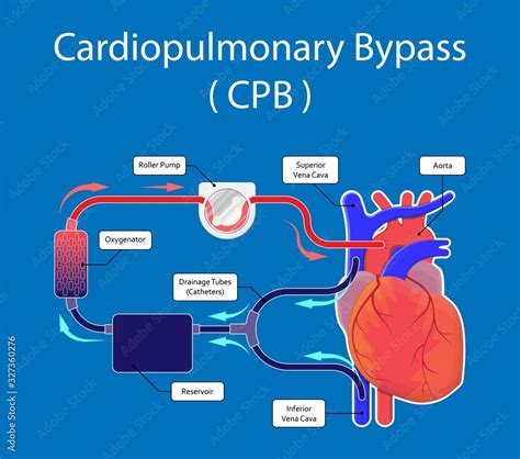 Cardiopulmonary Bypass Heart Lung Machine Coronary Oxygenator