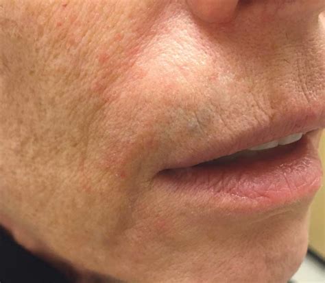 Peri Oral Dermatitis Rash Around The Mouth
