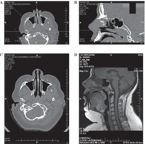 Figure 1 From Nasopharyngeal Chordoma In A Patient With A Severe Form
