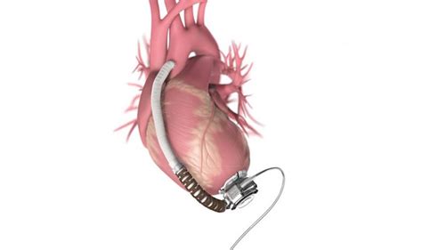 Fda Approves Abiomeds First In Human Trial Of Impella Ecp Worlds Smallest Heart Pump