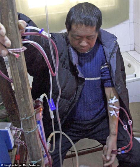 Chinese Man Kept Alive For 13 Years With Homemade Dialysis Machine