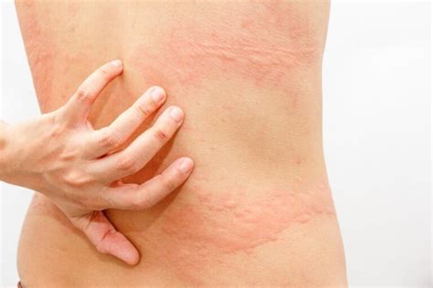 Get Rid Of Hives Swollen Red Bumps With This Simple Method Health