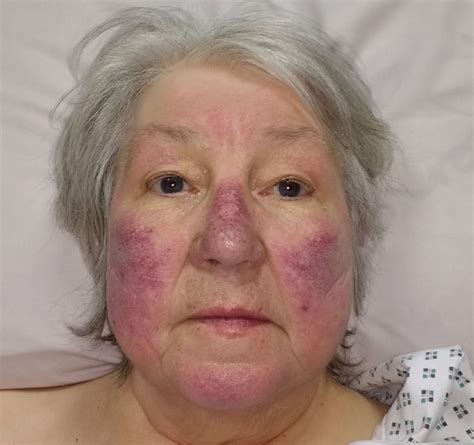 Malar Rash With Pulmonary Hypertension And Chronic Obstructive