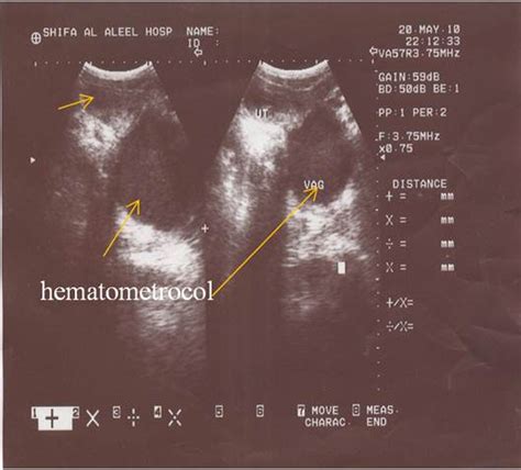 case report diagnosing of imperforate hymen by ultrasound science publishing group
