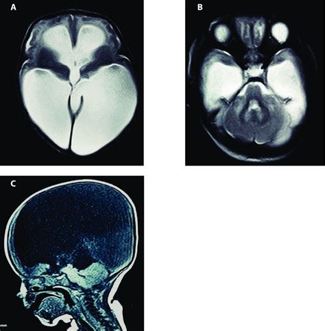 Brain Mris A Axial T2 Sequence Showing Dilated Lateral And Third