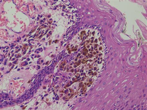 Head And Neck Primary Oral Mucosal Melanoma