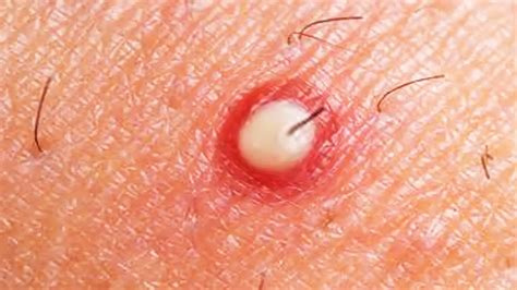 Ingrown Hair Worlds Largest Blackheads And Whiteheads Channel Youtube