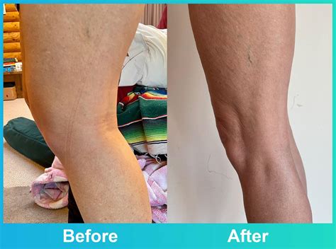 Anaya Is Back To Full Strength With The Paddison Program For Rheumatoid