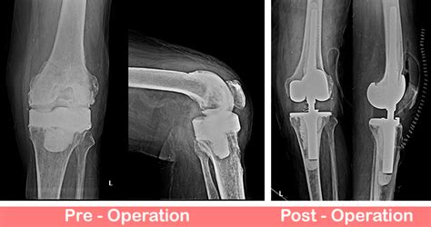 Revision Total Knee Replacement For Infection Rotating Hinge Knee