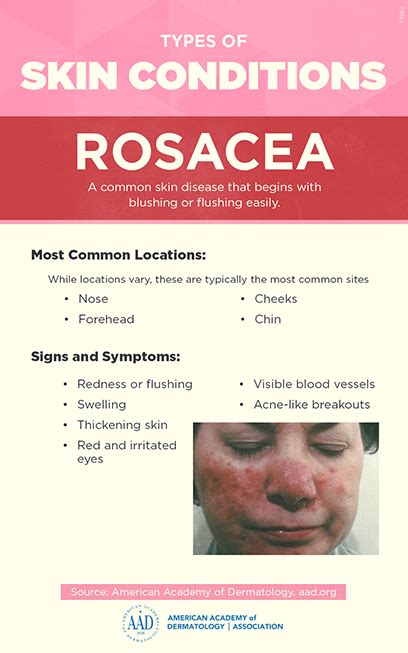 Rosacea Who Gets And Causes