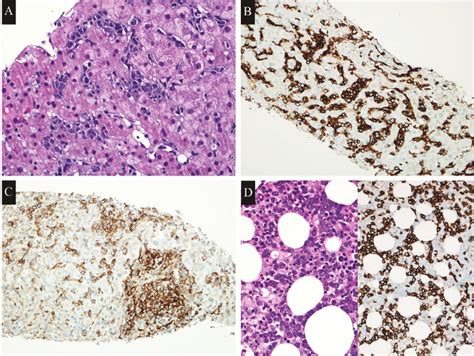 Primary Hepatosplenic Cd5 Positive Diffuse Large B Cell Lymphoma A