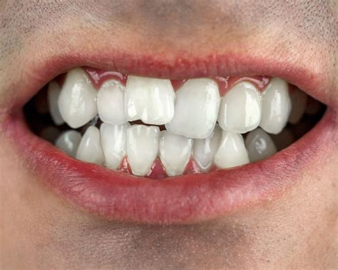 Say Goodbye To Crooked Teeth With Dental Veneers Dr Rebecca Rath Dmd