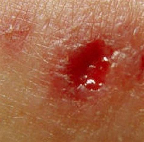 Wolf Spider Bite — Pictures Symptoms Treatment