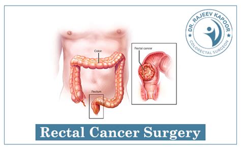 How To Treat Rectal Cancer Surgical Expert In Chandigarh