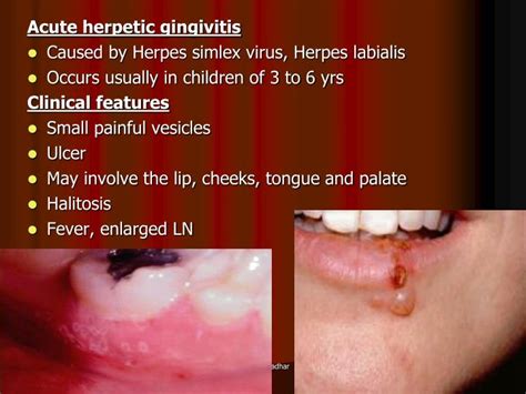 Ppt Gingivitis Inflammation Of Gingival Tissues Commonly Associated