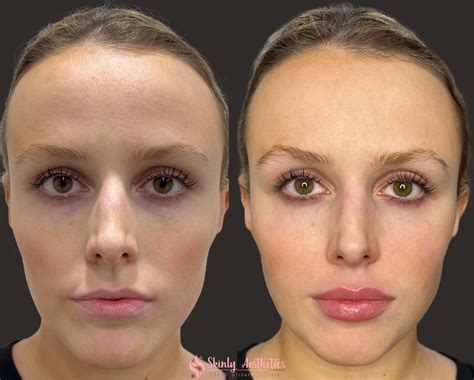 Lip Injections Before And After Juvederm