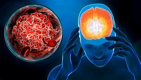 Trombose venosa cerebral o que é sintomas e tratamento Minha Vida