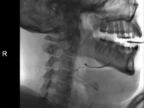 Submandibular Sialogram During Swallowing Dynamic Changes To Wharton