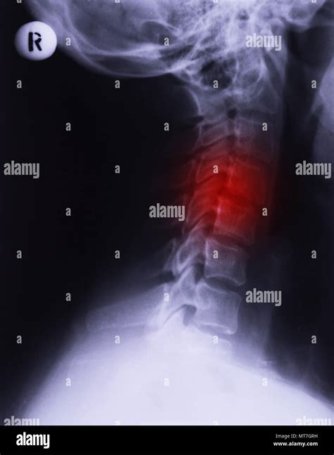 X Ray Of Neck Lateral Projection Cervical Sprain Rectification Of