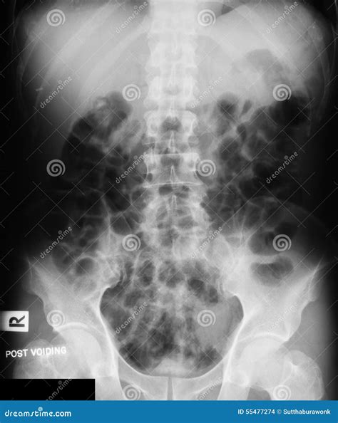 X Ray Image Of Ivp Supine View Stock Photo Image 55477274