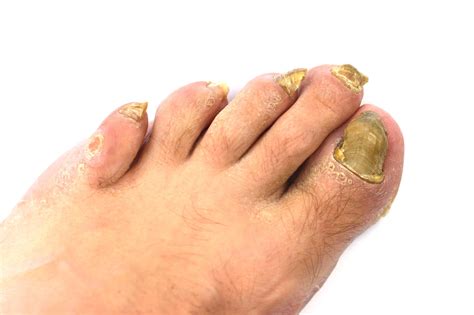 9 Natural Ways To Treat Toenail Fungus At Home Onychomycosis Help