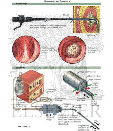 Percutaneous Nephrolithotomy Nephroscope And Sonotrode