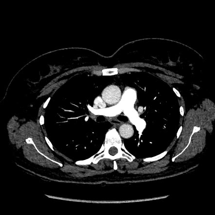 Pulmonary Embolism Protocol Chest Ct Scan Hot Sex Picture