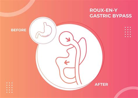 Roux En Y Gastric Bypass Rny Weight Loss Surgery Vector Illustration Icon 14818798 Vector Art At
