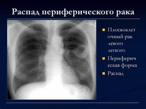 Диета при рак легких
