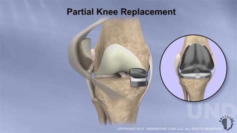 Partial Knee Replacement Procedure