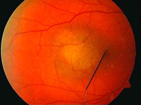 Color Fundus Photograph Of The Right Eye Of The Patient Download