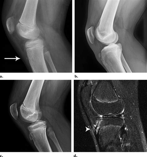 Osgood Schlatter Disease X Ray