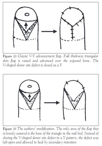 Volar V Y Advancement Flap For Fingertip Amputations Epomedicine